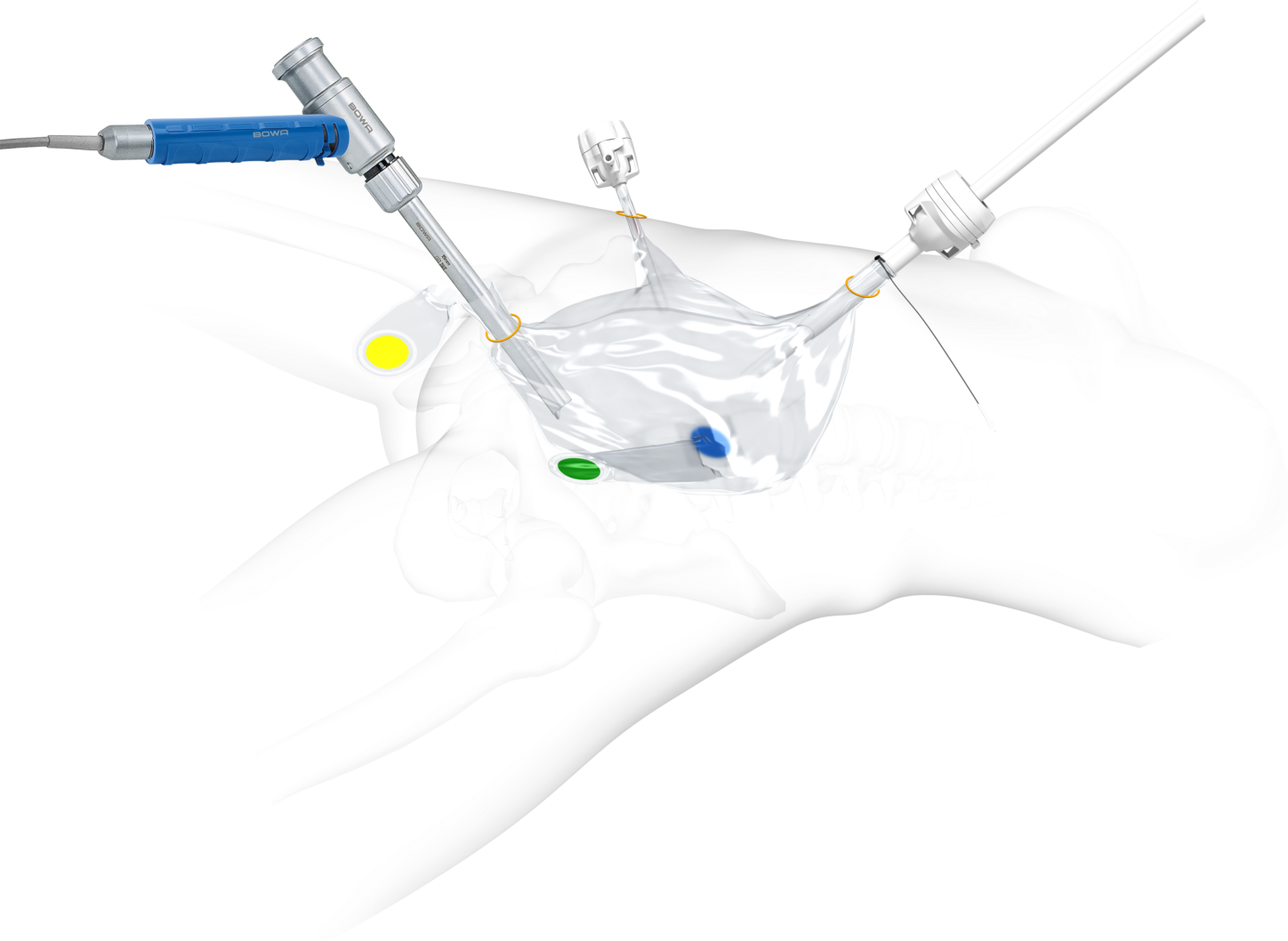 innovative-energy-based-surgical-solutions-bowa-medical-uk